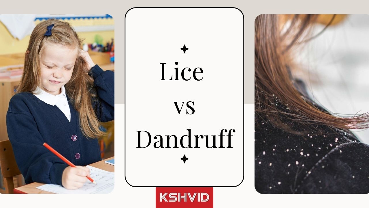 Lice vs. Dandruff: How to Tell the Difference