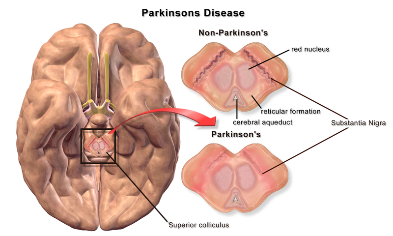800px-Blausen_0704_ParkinsonsDisease.jpg