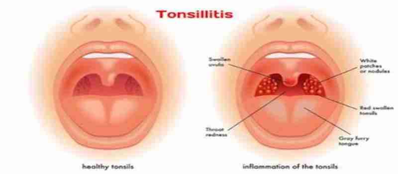 10-03-16-Tonsils_compressed.jpg