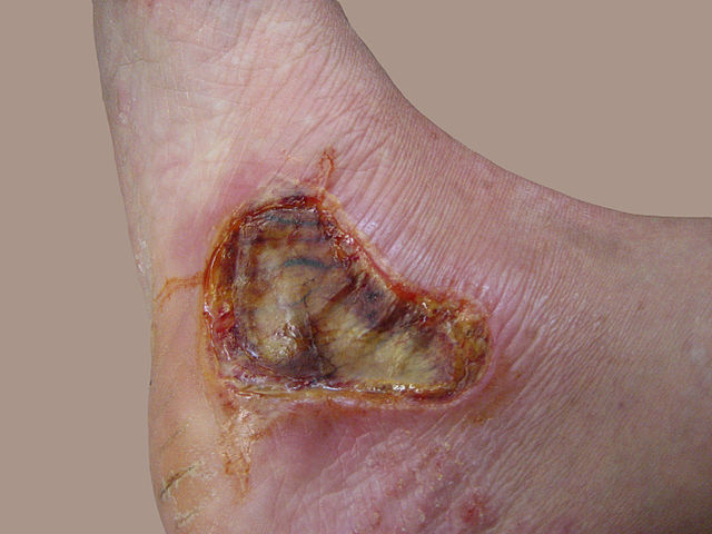 640px-8-day-old-3rd-degree-burn.jpg