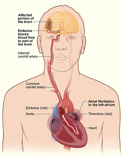 Atrial_fib_stroke.jpg