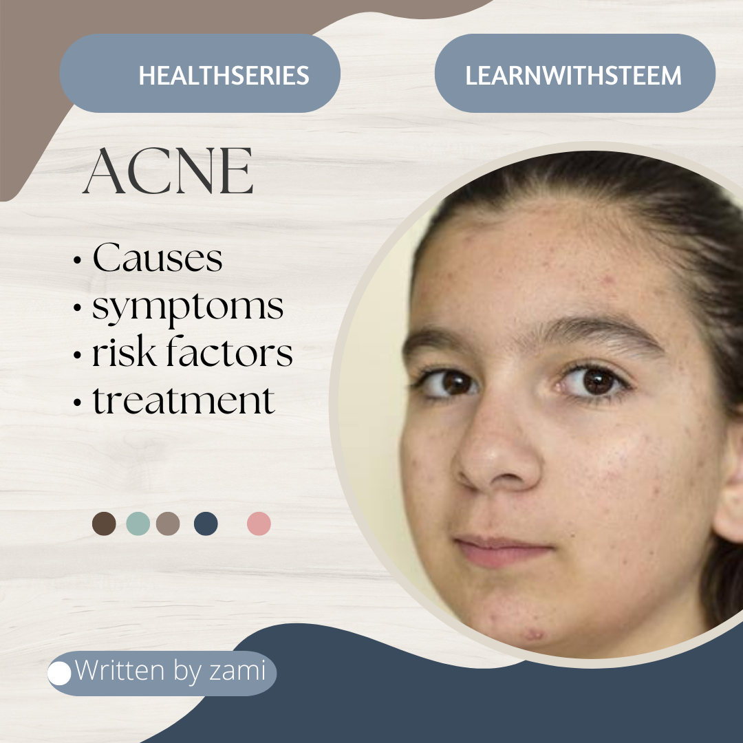 health-series-acne-symptoms-causes-risk-factors-diagnosis-and-treatment-steemit