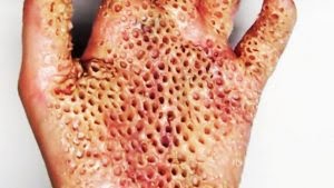 Penyakit Tangan Bolong Atau Trypophobia Ketahui Penyebab Dan Gejalanya Merdeka Com