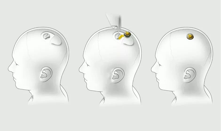 neuralink-installation (1).webp