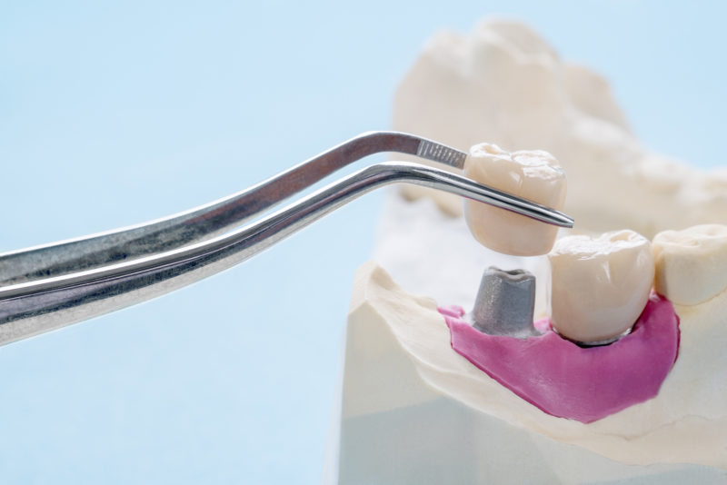 Are-Dental-Crowns-Bad-for-Your-Teeth-800x534.jpg