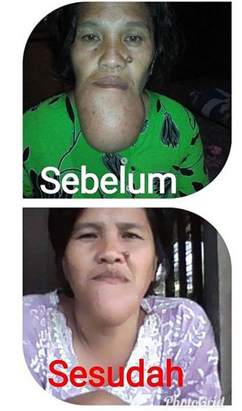 tumor mandibula.jpg