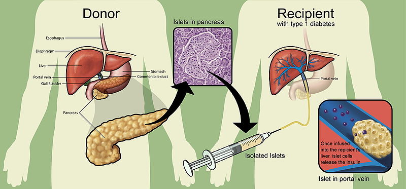 islet transplantation.jpg