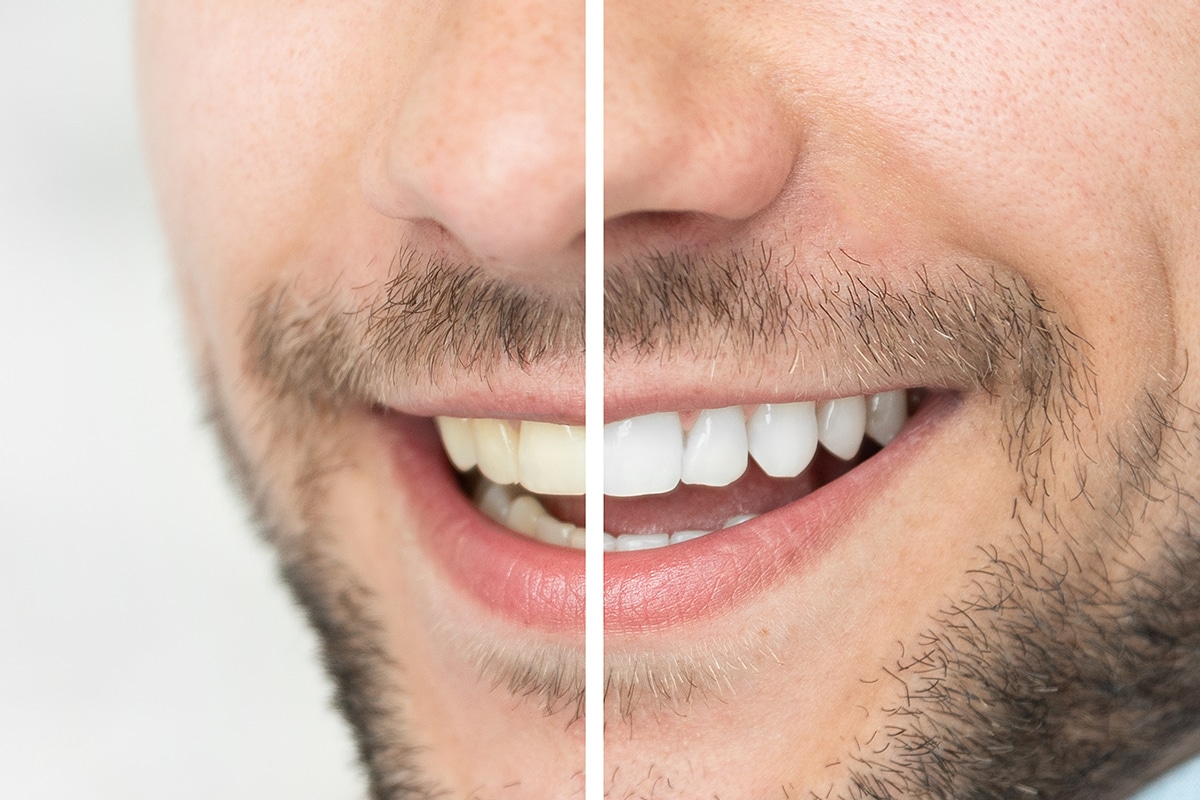6 Common Mistakes People Make After Teeth Whitening.jpg