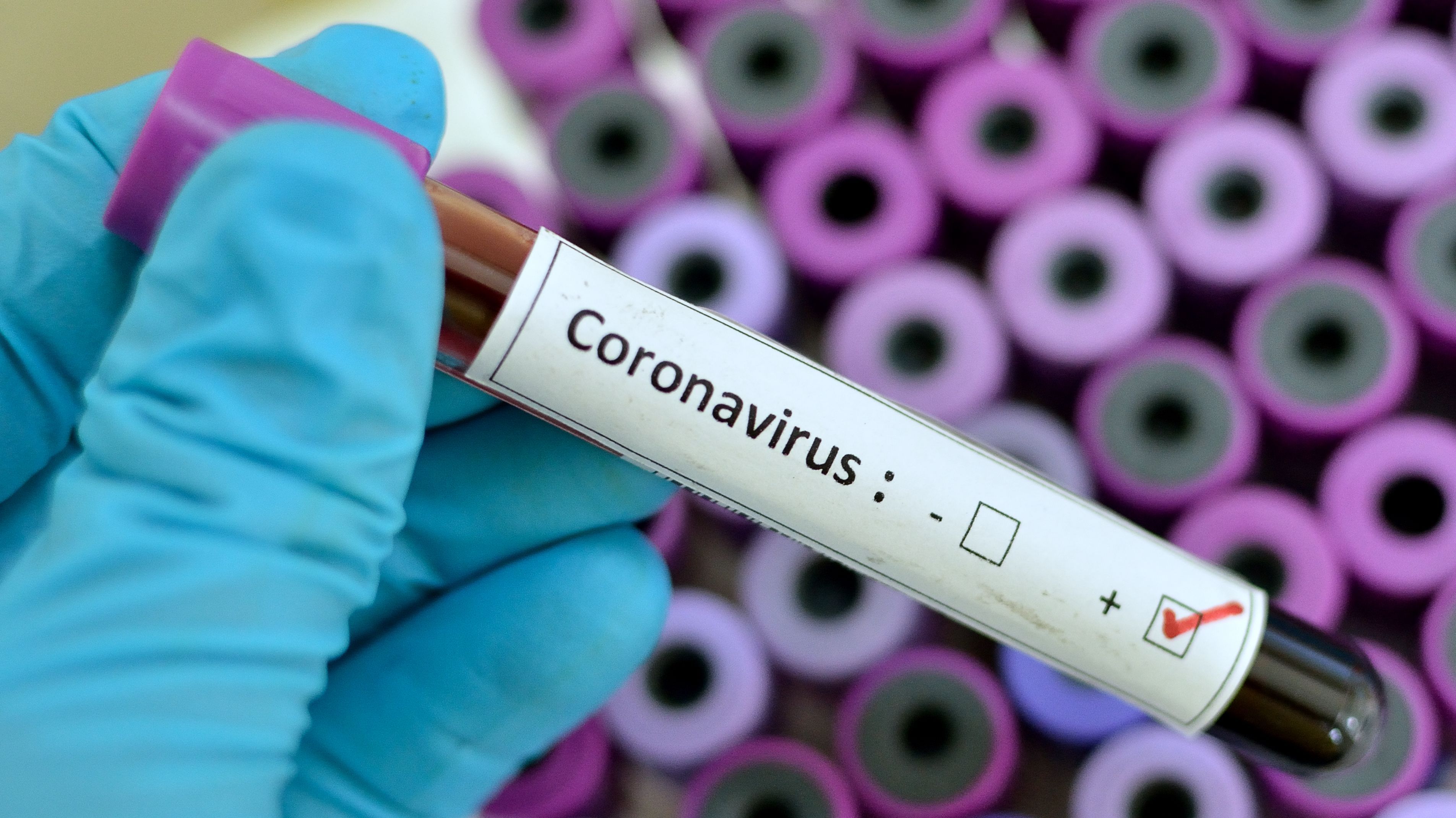 2020People_Covid-19_coronavirus_test_tube_in_hand_142365_.jpg