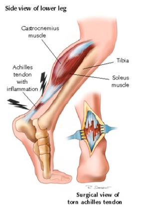 tendon.jpg