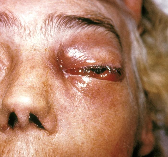 Periorbital_fungal_infection_known_as_mucormycosis,_or_phycomycosis_PHIL_2831_lores.jpg
