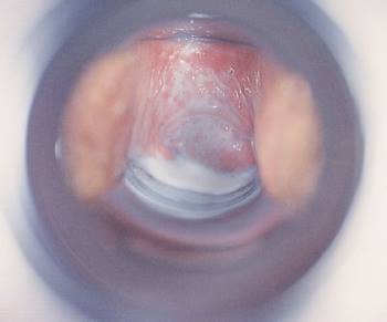 speculum_exam_bacterial_vaginosis_high.jpg