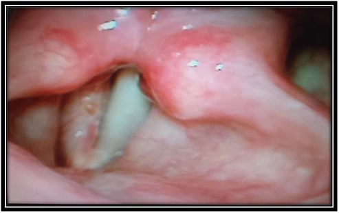 quiste mucoso cuerda vocal