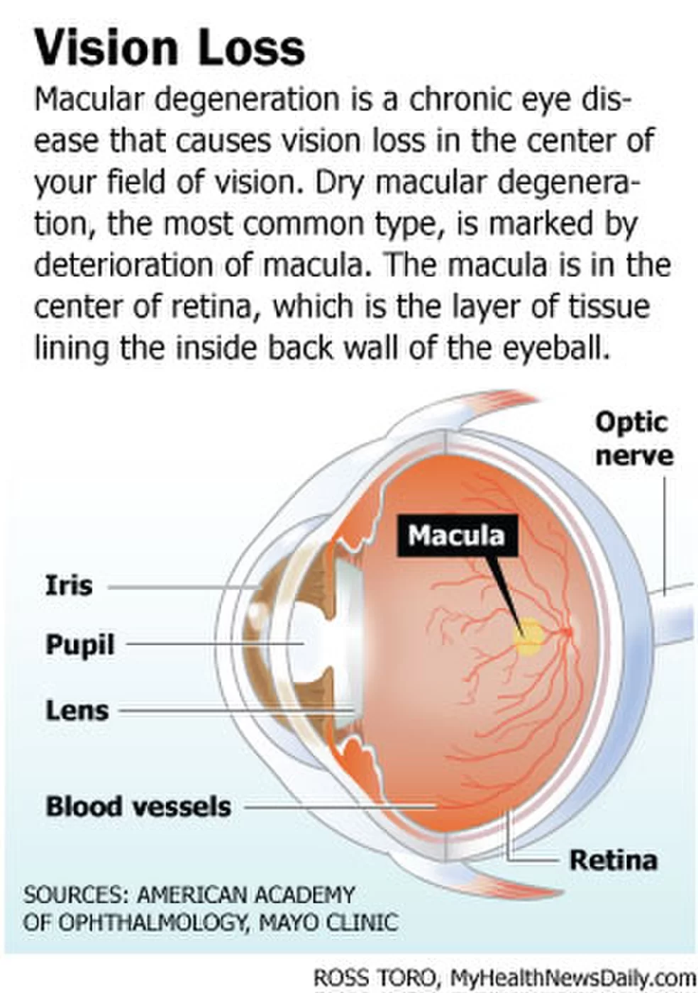 Vision loss. Дегенерация желтого пятна. Дегенерация желтого пятна глаза. Дегенерация желтого пятна симптомы.