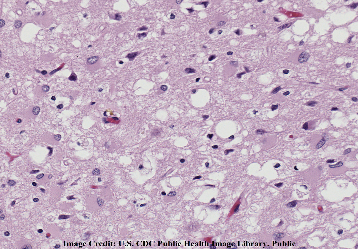 cjd variant tissue public cdc.jpg
