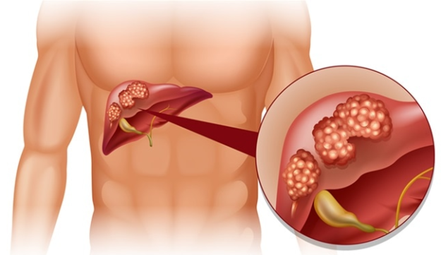 Tumor HATI.png