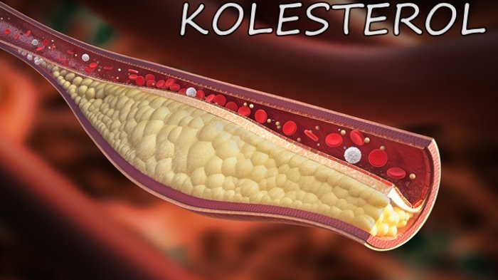 kolesterol_20180618_091443.jpg