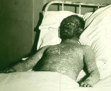 Hemorrhagic_smallpox_2_(cropped).jpg