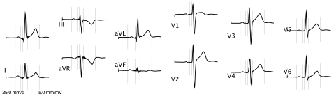 ECG_12derivations.png