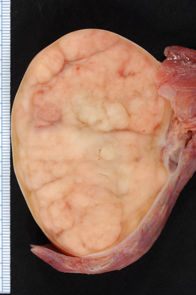 Seminoma_of_the_Testis.jpg