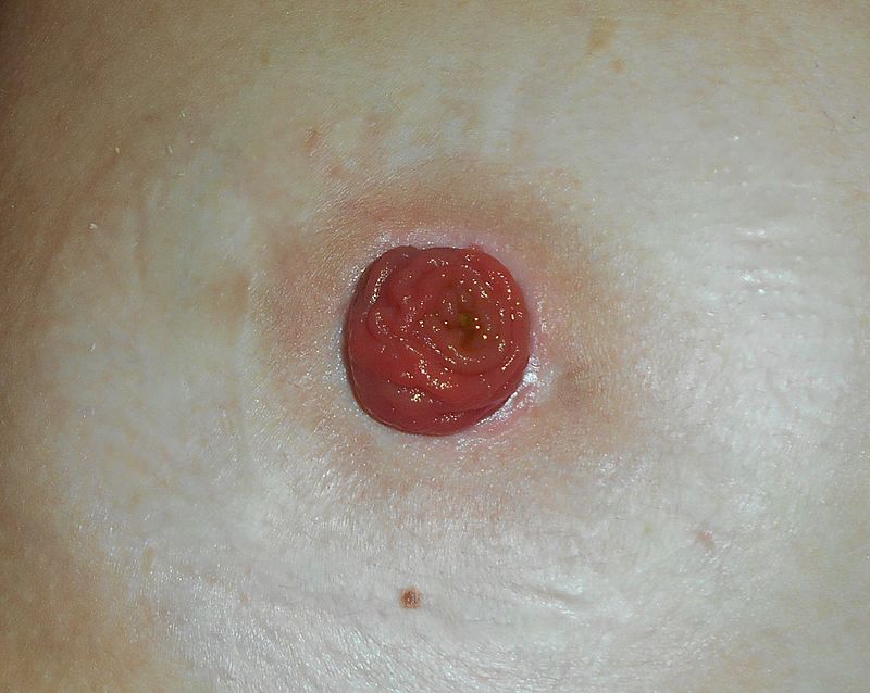 Ileostomy_2017-02-20_5349.jpg