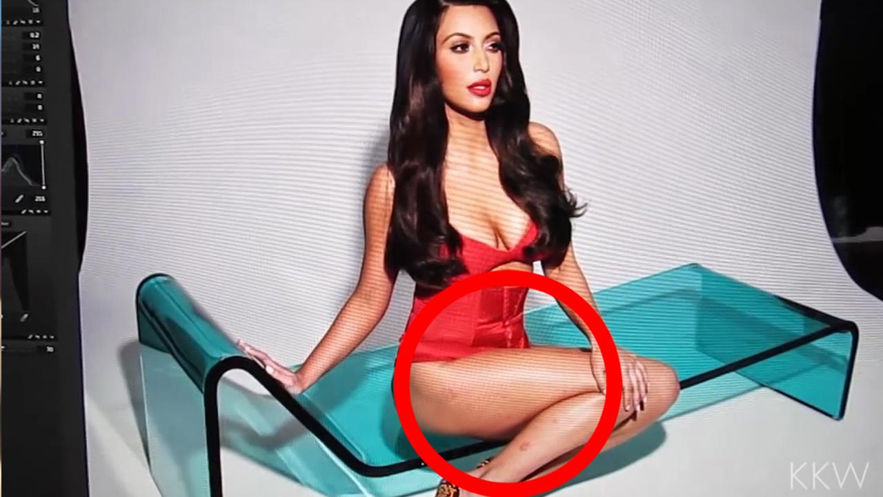 psoriasis Kim.jpeg