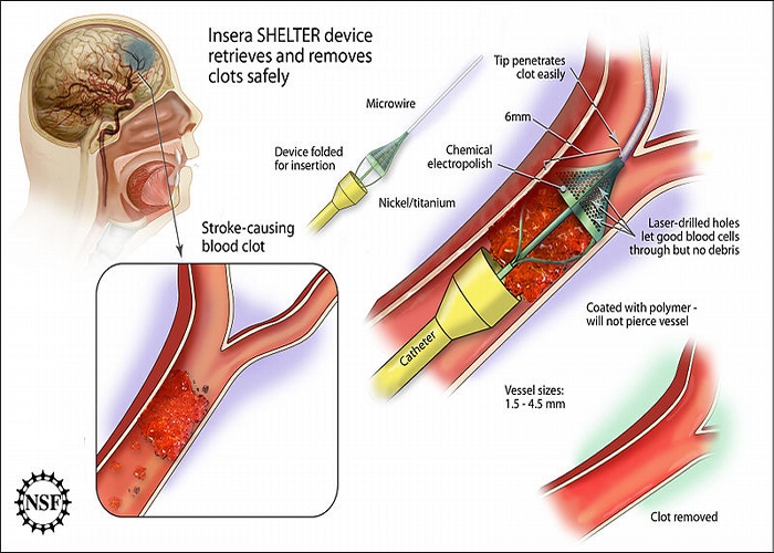 Blood_clot_removal1.jpg