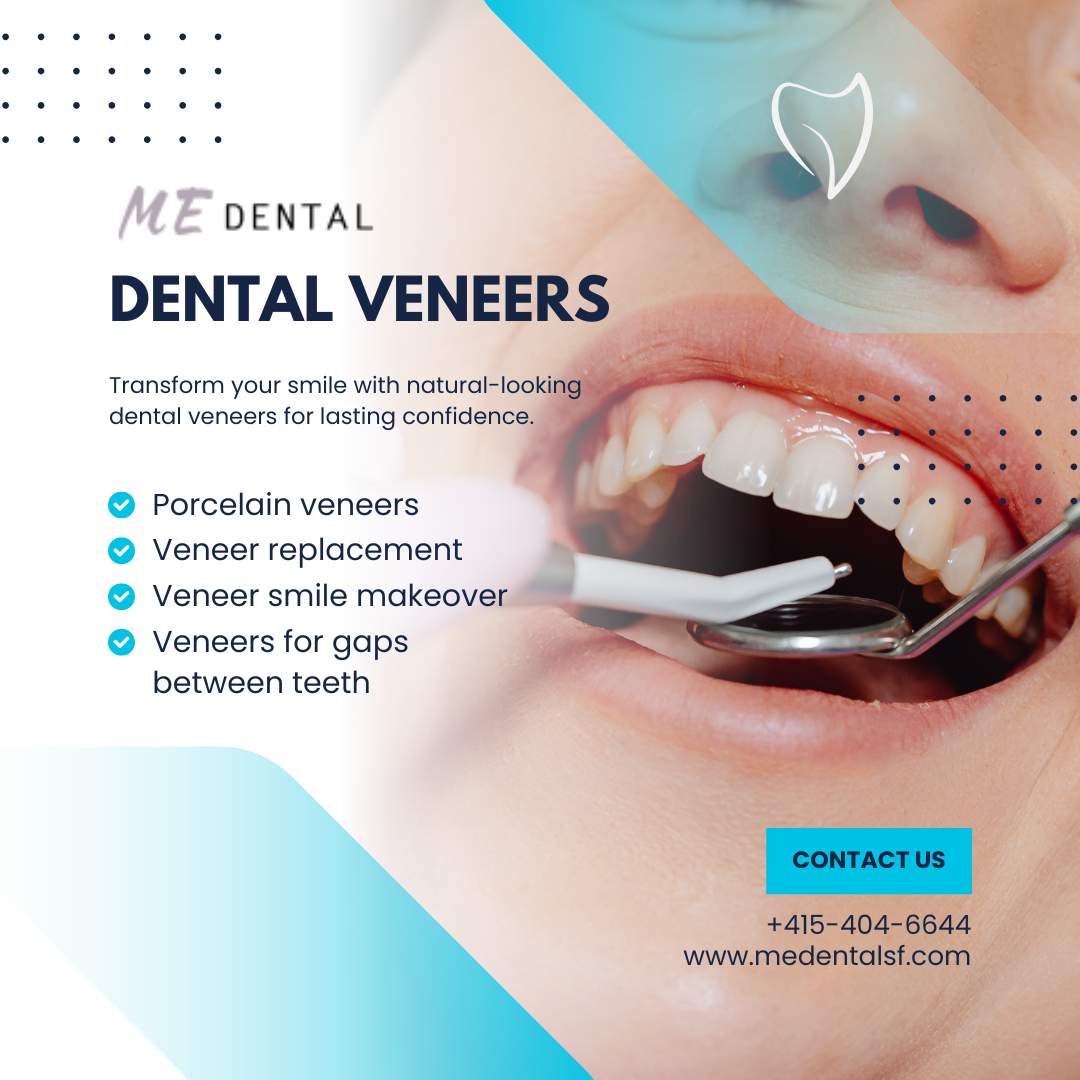 Dental Veneers in San Francisco.png