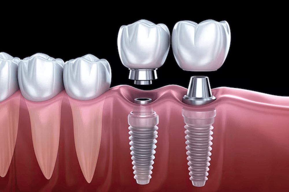 8 Surprising Steps in the Dental Implant Procedure What Happens Between Consultation and Your New Tooth.png