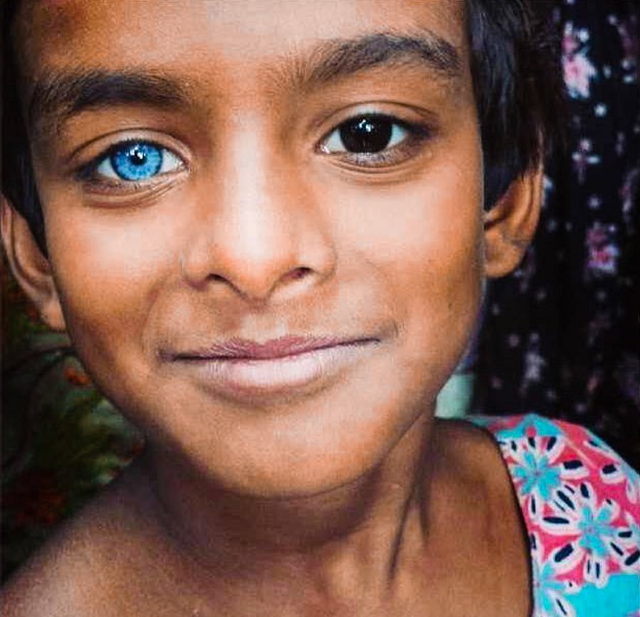 humans with different colored eyes