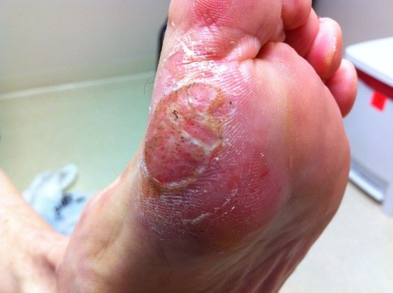 feet wart.jpg