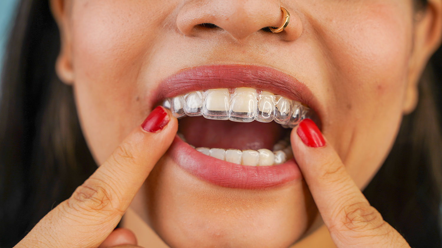 7 Yes For Invisalign Treatment.jpg