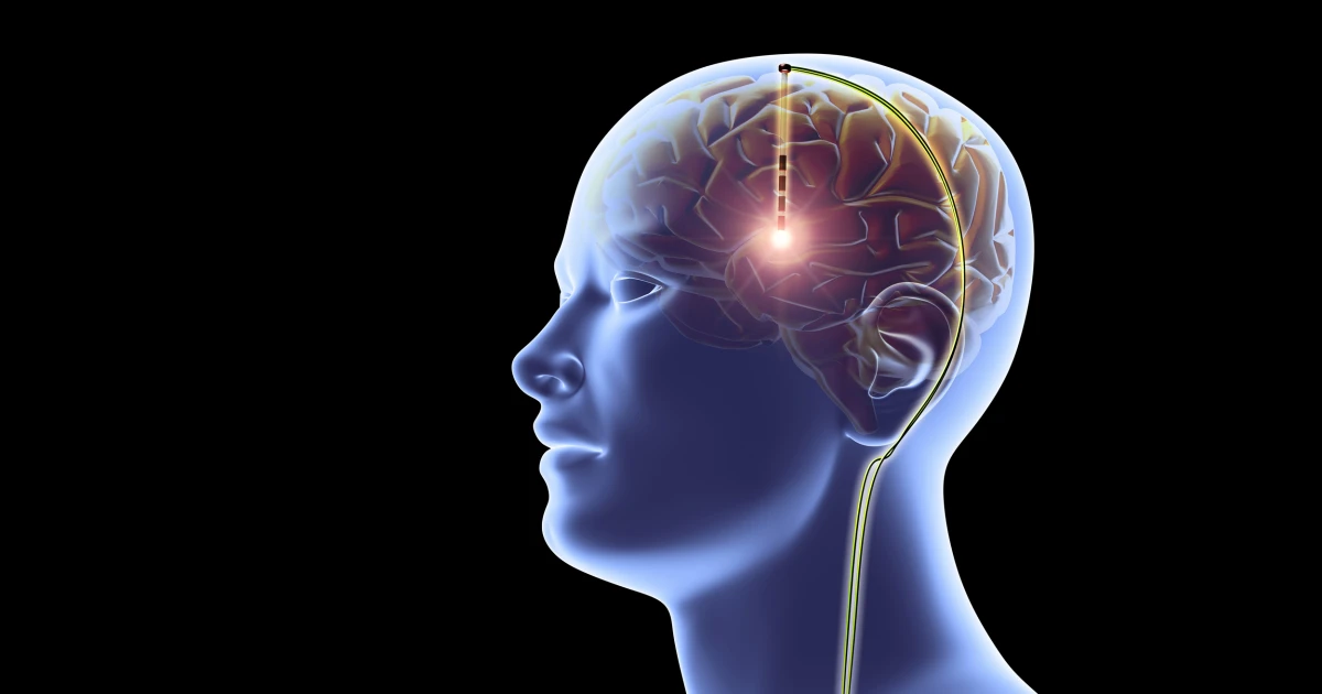 180423-brain-implant-mn-1350.webp