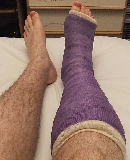 440px-Purple_short_leg_cast.jpeg
