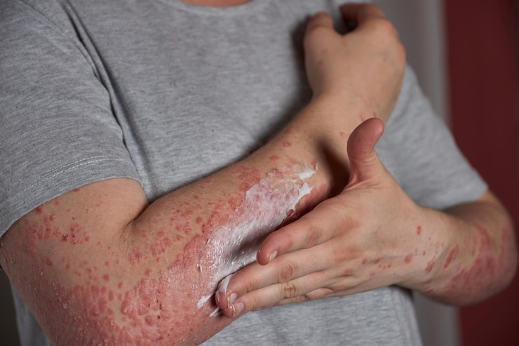 best eczema cream for adults.jpg