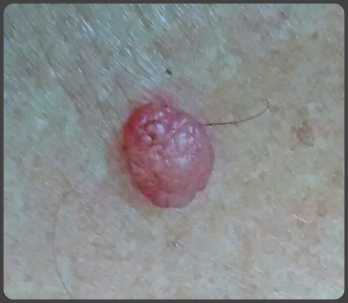 nodulo.jpg