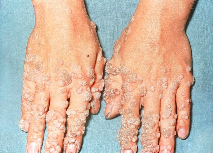 hand wart.jpg