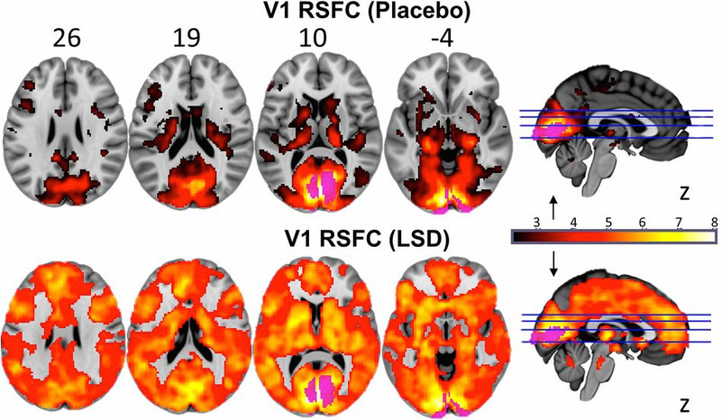 your brain on LSD.png