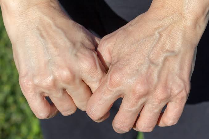 Visible Hand Veins When Should You Consider Specialised Treatment.jpg