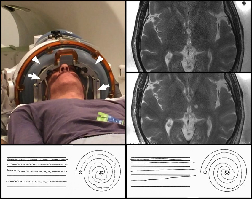 ENGLISH-Figure-1-Top-left-patient-with-tremor-lying-on-the-detachable-treatment-table.png