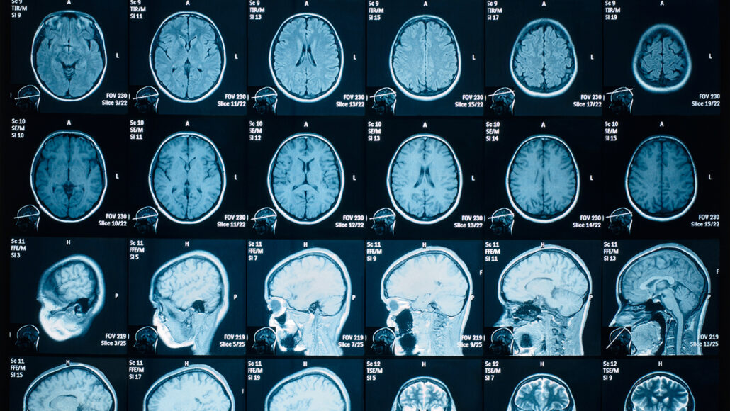 031622_ls_brainshrink_feat-1030x580.jpg
