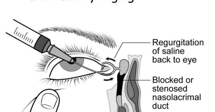 Lacrimal Cannulae1.jpg