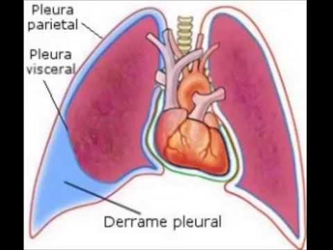 derrame pleural.jpg