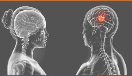 brain tumor.png
