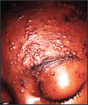 people_shingles Zoster Ophthalmicus.jpg