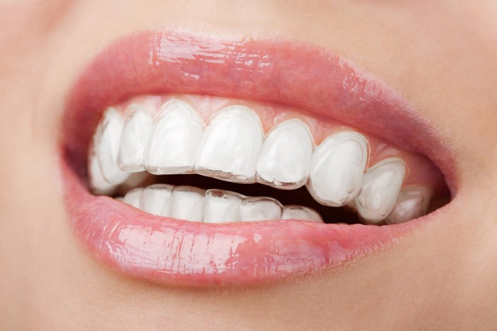 8 Teeth Straightening Methods That Can Help You Smile with More Confidence.jpg