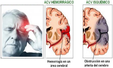 tipos de ACV.jpg
